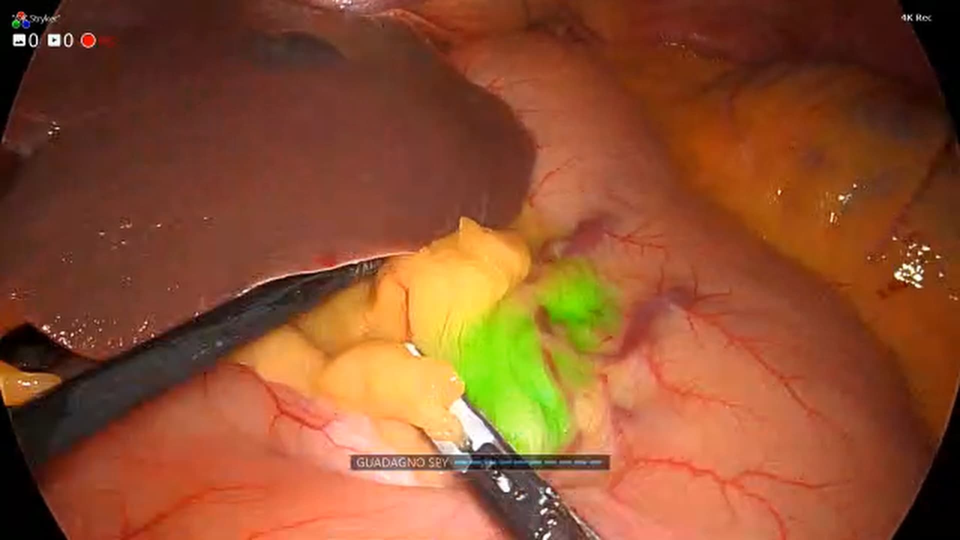 Gastrectomia subtotale laparoscopica ICG-guidata per cancro gastrico antrale