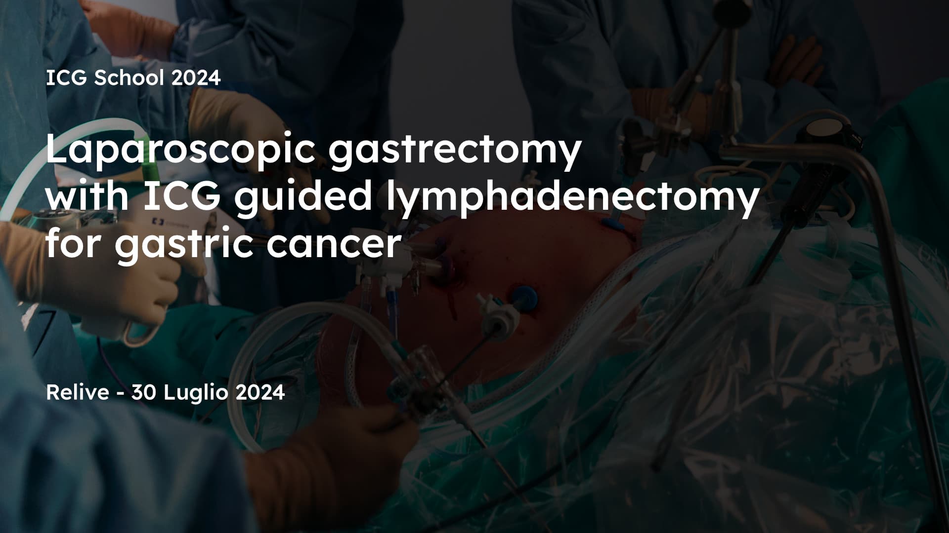 Laparoscopic gastrectomy with ICG guidedlymphadenectomy for gastric cancer
