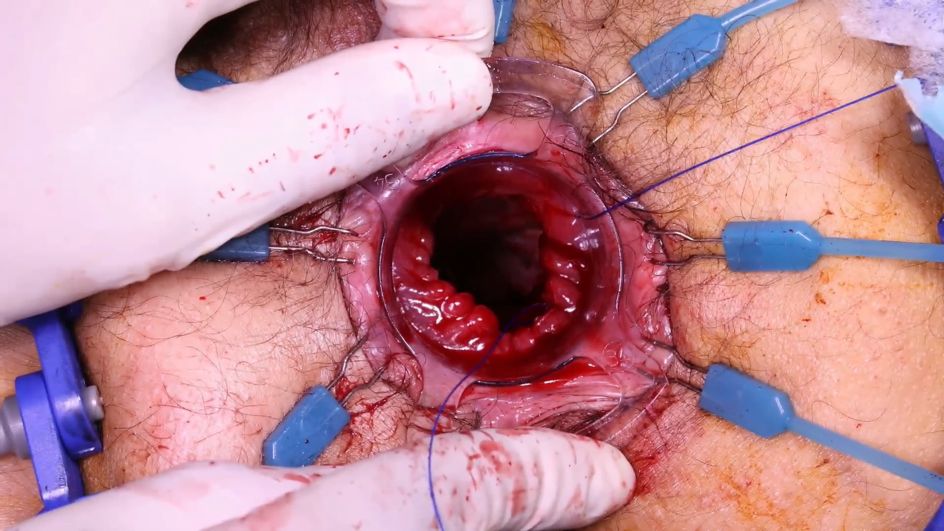 TME laparoscopica con anastomosi transanale single stapled (TTSS) per cancro del retto basso